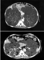CT photos of kidney disease patient before and after therapy